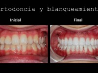 088-Ortodoncia y blanqueamiento